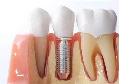 ایمپلنت یا کاشت دندان برای چه افرادی مناسب است؟
