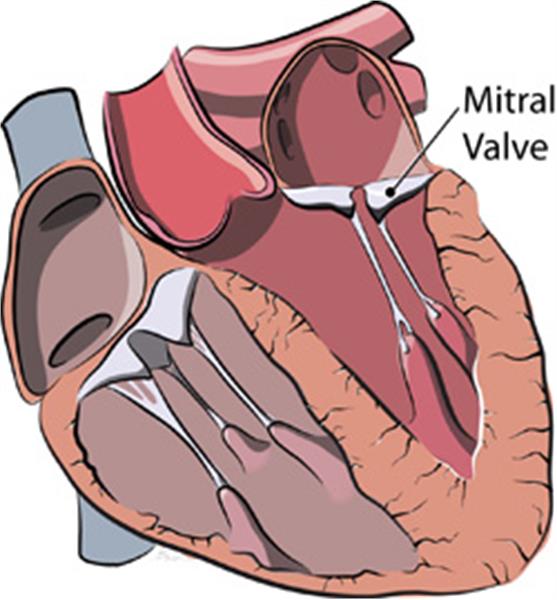 علائم افتادگی دریچه میترال قلب (MVP)