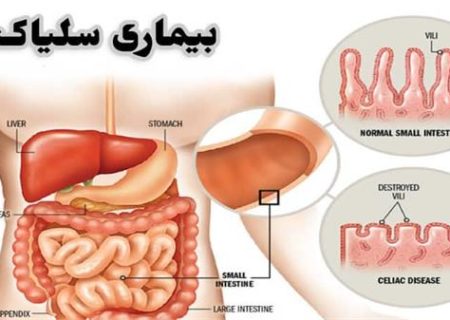 بیماری خودایمنی گوارشی به نام سلیاک