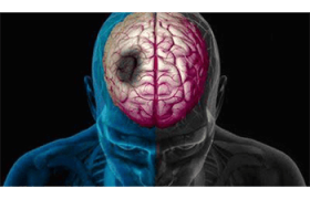 نجات جان ۳۴ بیمار سکته مغزی در کرمانشاه