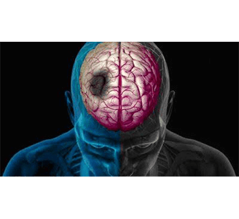 نجات جان ۳۴ بیمار سکته مغزی در کرمانشاه